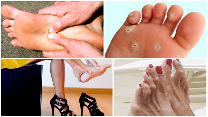 Осложнения у пациентов с полой стопой