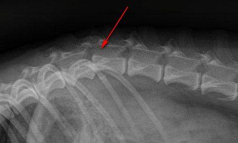Остеохондроз грудного отдела позвоночника на рентгене