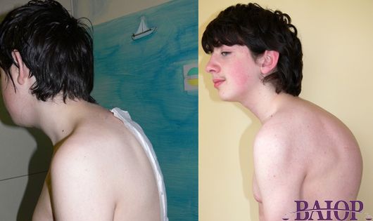 Парень с искривленной спиной