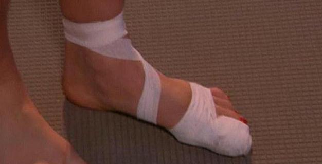 перелом ногтевой фаланги большого пальца ноги