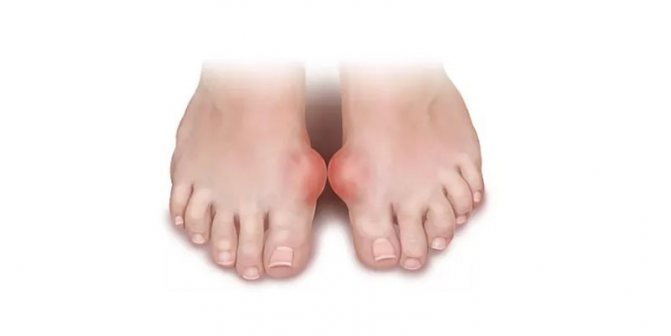 Подагра на ногах