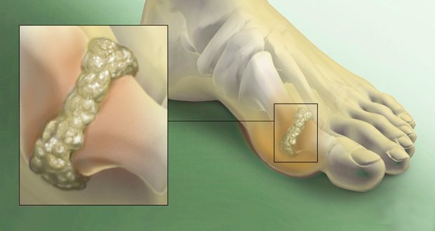 подагрический узел