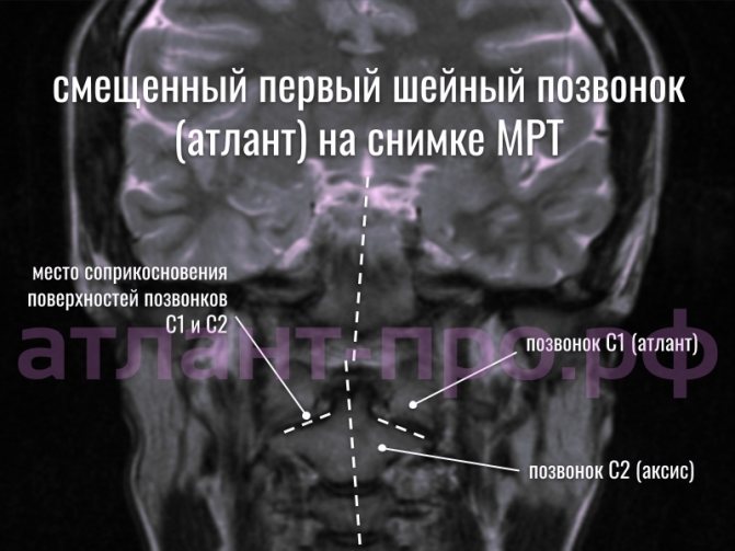 Подвывих позвонка атланта на снимке МРТ