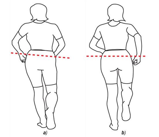 После эндопротезирования удлиниться нога