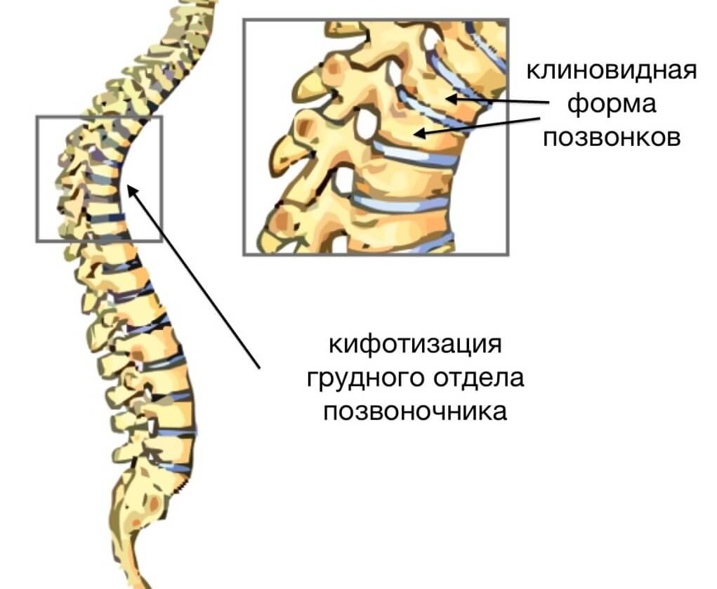 позвоночник при кифозе