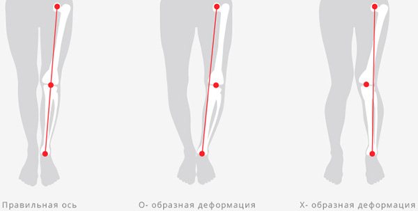 При правильной форме ноги линия, соединяющая тазобедренный сустав и стопу, проходит через центр колена