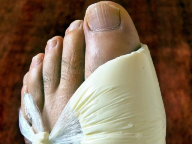 Приступ подагры – это воспаление сустава, сопровождающееся очень сильной болью