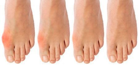 прогрессирование подагрического приступа