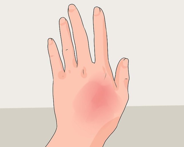 Психосоматика ожога: причины, психологические проблемы и методы лечения