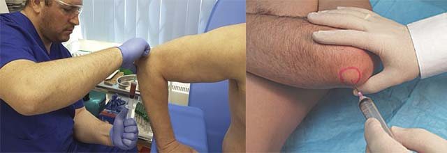 Пункции локтя