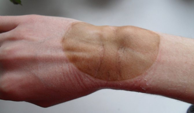 Разогревающая мазь Финалгон: описание и применение, как правильно смыть со спины и с кожи при жжении