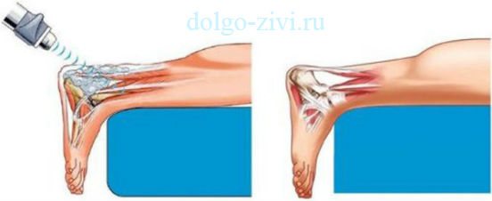 разрушение шпоры