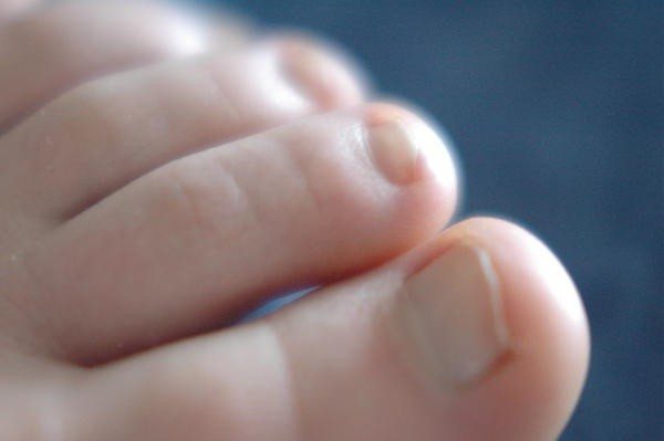 рентген стопы