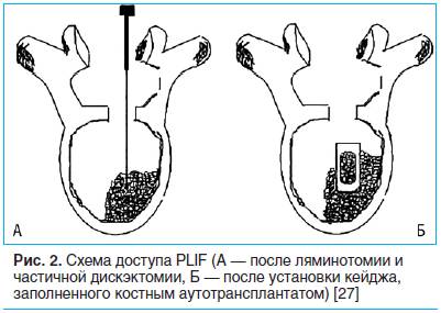 Рис. 2. Схема доступа PLIF