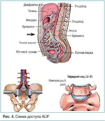 Рис. 4. Схема доступа ALIF