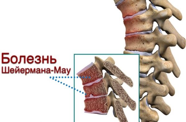 Считается, что причиной болезни Шейермана-Мау является наследственность, но точных подтверждений этому нет