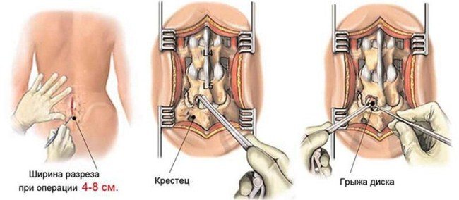 Схематично процедуру можно представить таким образом