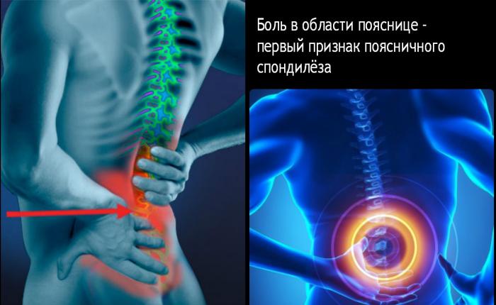 Симптомы спондилеза