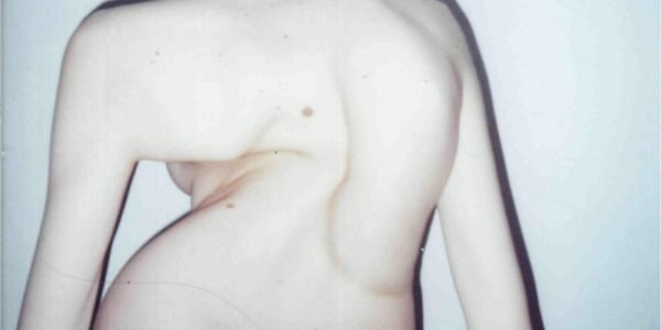 Сколиоз 4 степени