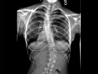Сколиоз первой степени диагностируют, преимущественно, с помощью рентгена