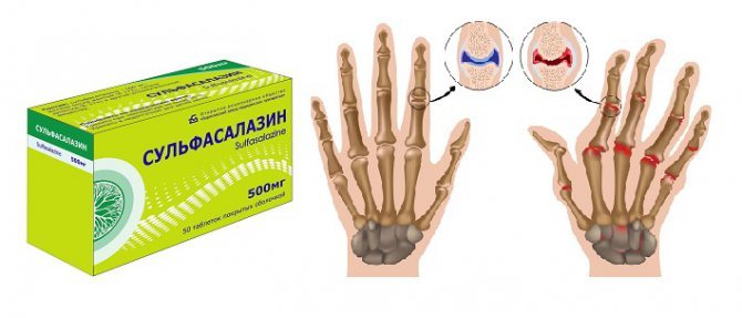 Сульфасалазин при ревматоидном артрите: отзывы и инструкция по применению