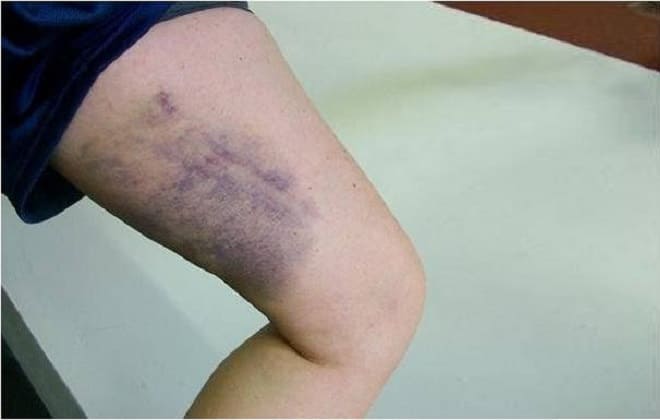 Темные подкожные кровотечения