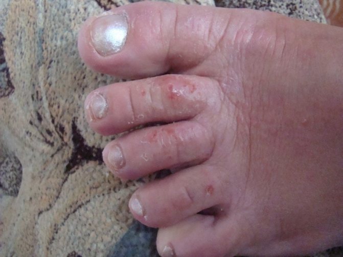 трещина между ягодицами у взрослых причины фото