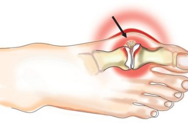 Уколы от подагры лучшие