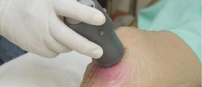 Ультразвук с гидрокортизоном при заболевании суставов