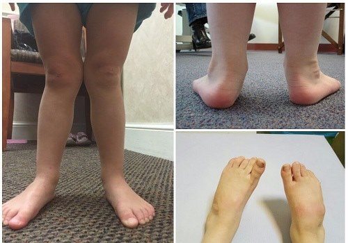 Вальгусная деформация у детей