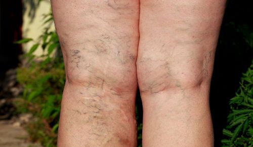 Варикоз ног