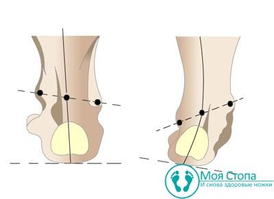 Варусная деформация стопы у детей