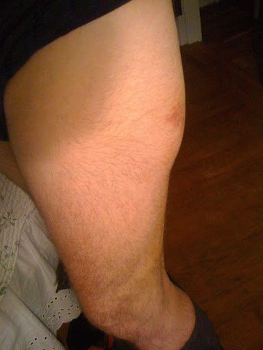 Виды и симтомы ушиба мягких тканей бедра