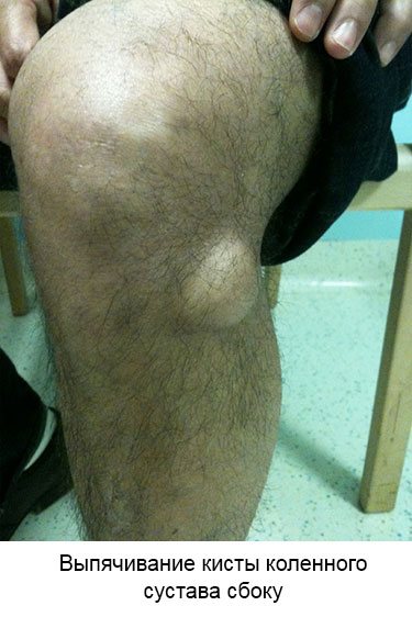 выпячивание кисты сбоку колена