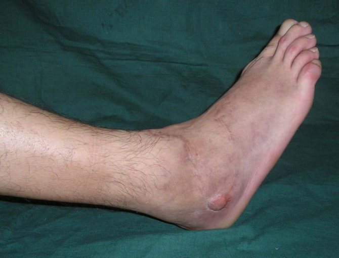 Закрытый перелом ноги